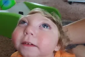 美国先天无脑畸形男婴存活 因疾病头骨和脑部残缺图片