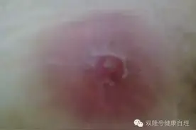 中医说痈。图片