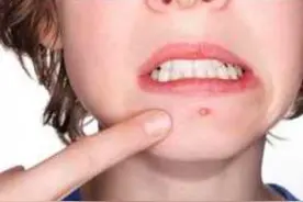 疏通胃经，嘴边痘立消停图片