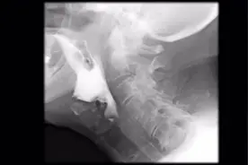 医学科普短片：正常吞咽与误吸的区别在哪里？