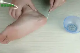 脚后跟开裂起皮，红霉素加蜂蜜涂涂，皮肤白嫩光滑，告别干裂