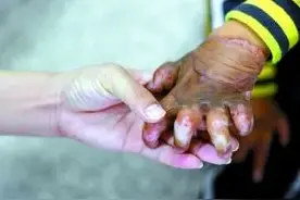 重疾险产品中“Ⅲ度烧伤”的理赔实务及探讨图片