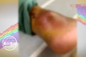 5岁男孩被蚊子叮，竟然严重到要动手术：伤口里面全是脓液图片
