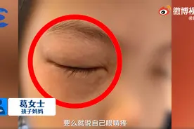 女孩一做数学题就眼睛过敏：眼睛肿到睁不开图片