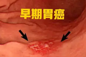 同学父亲腹痛消瘦做胃镜，结果一出来抱头痛哭，“我该早来的”图片