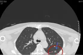 肺结节个体化手术治疗方案展示图片