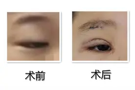 眼睛无神，总感觉睡不醒，警惕！可能是上睑下垂【呱呱教·164】图片