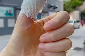 杭州姑娘一个手贱，整片指甲盖都被拔了…图片