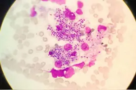 医生的恶魔，病人的死神！噬血细胞综合征来袭，生死边缘图片