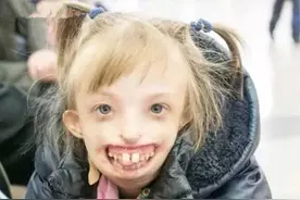 俄罗斯女童没有嘴唇和下巴，面容让人惊惧，经过手术终于展开笑颜图片