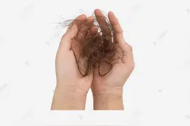 为什么人每天掉头发却不会成秃头？怎么有效防治脱发？图片
