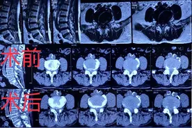 腰痛十年未就医 如今十米难行走 哈医大一院骨科专家微创手术40分钟解决病痛图片