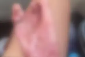 湖南一职校生在工厂实习时致残：右手绞入机器皮肤脱落，两手指截肢图片