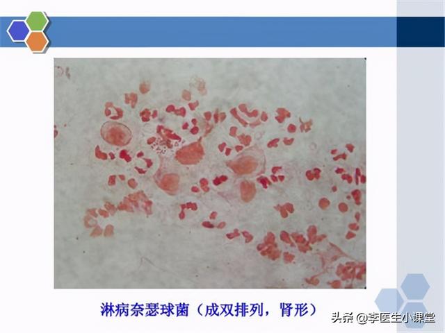 “淋病”是什么？如何治疗和预防？