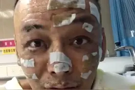 早日康复！歌手自曝因点燃香薰蜡烛引发火灾，全身二级深度烧伤图片