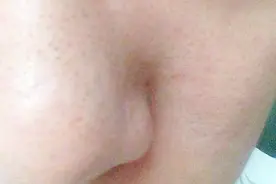 用这些常见物品自己调制，可以解决脸上毛孔粗大问题视频封面