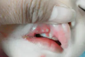 舌头长泡很难过，这可如何是好，别担心让我来帮助你解决这个问题视频封面