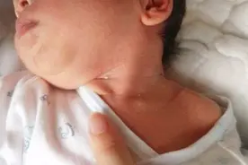 宝宝出现脖子红是怎么回事？家长别慌，儿科医生教你如何护理！