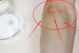 胳膊肘发黑难看，用不值钱的它抹一抹，轻松解决这个难题