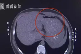 贪杯奶茶致胆囊炎 网友：可能要变蚌图片