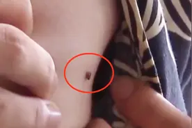 蜱虫钻进男子胸口，医生夹出时竟然还活着，这也太吓人了吧视频封面