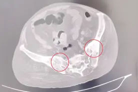 一位典型强直性脊柱炎患者CT图像，骶髂关节已经出现局部融合了