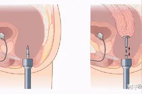 妇科手术告别瘢痕，腹腔镜手术圆您爱美的梦图片