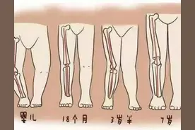 孩子腿弯，怎么判断是否有问题？图片