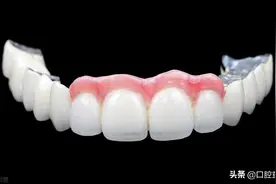 烤瓷牙并不是用一辈子的，如果有了以下状况说明你的烤瓷牙该换了图片