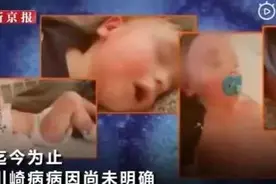川崎病突袭儿童，孩子持续高烧，需警惕这种病，可造成心脏损害图片