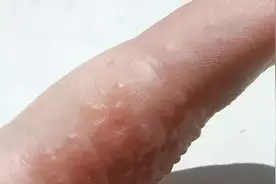 一到夏天手上就起“小水泡”，千万别忽略，当心是汗疱疹图片