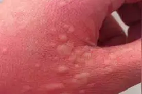 身上起红疙瘩，越抓越痒怎么回事？了解这七大诱因，还你光洁皮肤