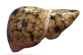 致脂肪肝患者：为健康着想，这4类食物咬牙也不吃，别当耳旁风图片