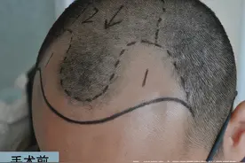 「植发是怎么移植上去的？」湖南省中医药研究院附属医院图片