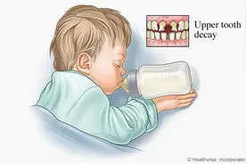 儿童严重蛀牙竟然会引起脏器健康？北大口腔医院儿科医师的护牙攻略有哪些？图片