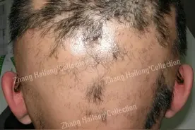 "斑秃"都有哪些治疗？图片