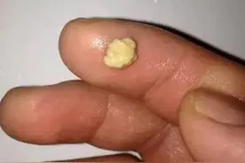 咽部有异物感，用力一咳，咳出很臭的“小石头”？经历过的看过来图片