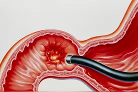 为什么会产生十二指肠溃疡？它症状有哪些？治疗时应该注意什么？图片