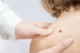 身上长的痣，到底要不要祛除？图片