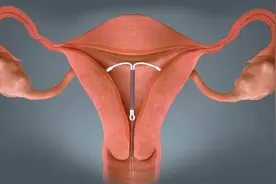 “残害一代中国女性”的节育环，今日我想为它说上几句公道话图片