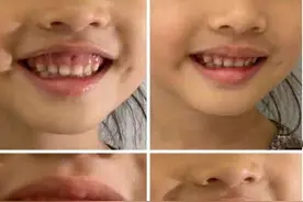 孩子笑起来总会露出牙龈，千万别忽视，这个时候矫正最好图片