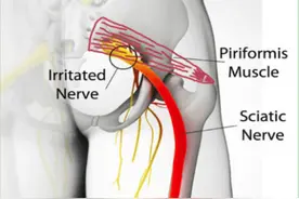单边屁股疼很可能是因为这种病图片