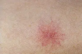 皮肤上有蜘蛛痣，代表肝不好了？先别慌，医生教您如何辨别真假图片