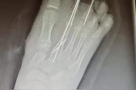 父亲转身接了个电话，女儿少了两根脚趾！医生提醒，断指（趾）保存方法及再植“黄金时间”十分重要图片