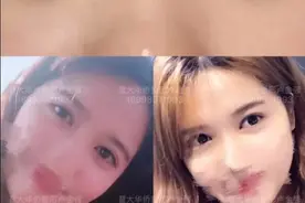 双眼皮术后恢复5个阶段该怎么护理？图片