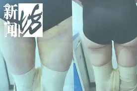 自爆！一个奶爸羞于启齿的抽脂故事，抽脂需谨慎图片