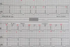 交界性心律合并房室分离、窦性夺获、竞争心律图片