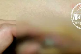 男童身上溃烂穿孔，还不敢告诉家长！直到清洗内裤时才发现血渍图片