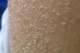 你们腿上会掉白屑吗？图片