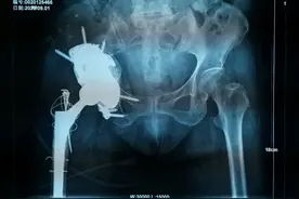 哈医大一院完成我省首例金属3D打印三翼髋臼假体全髋关节翻修术图片